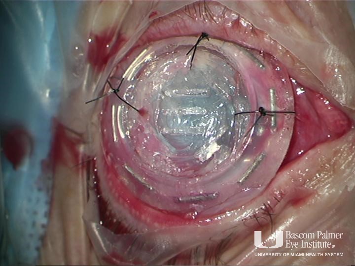 Conjunctival melanoma treated with I-125 brachytherapy