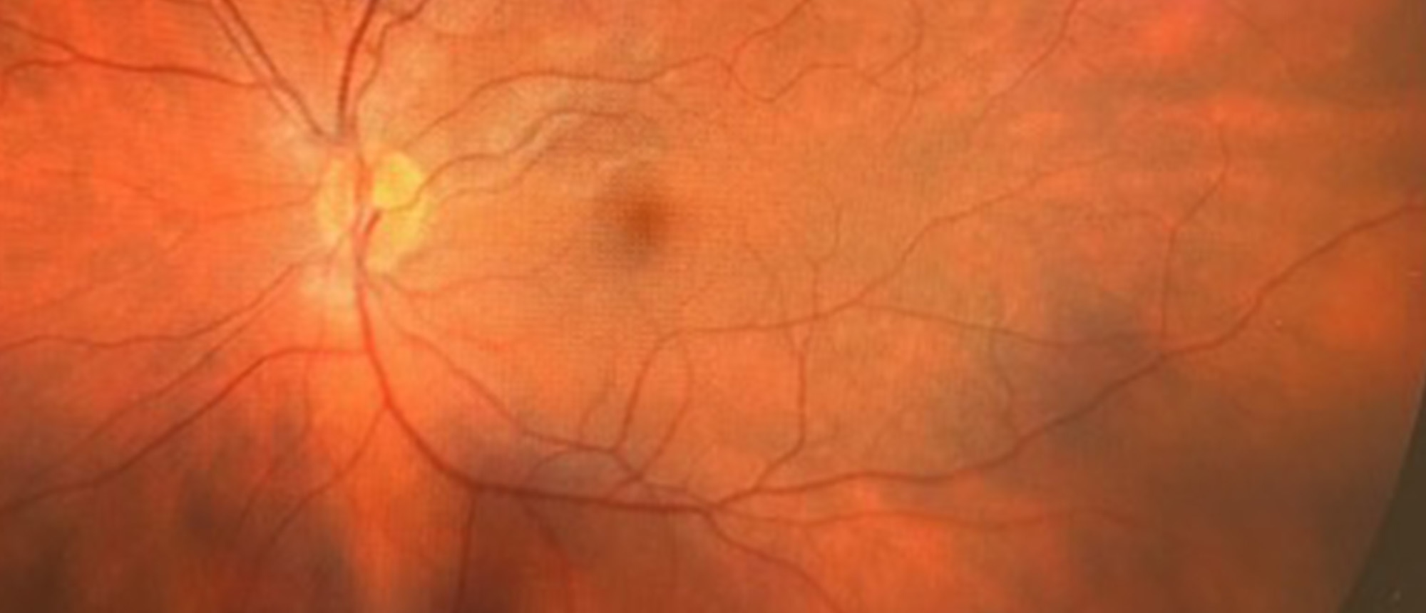 Prothrombin G20210A Mutation and Hyperhomocysteinemia in Young Patient with Non-Arteritic Ischemic Optic Neuropathy