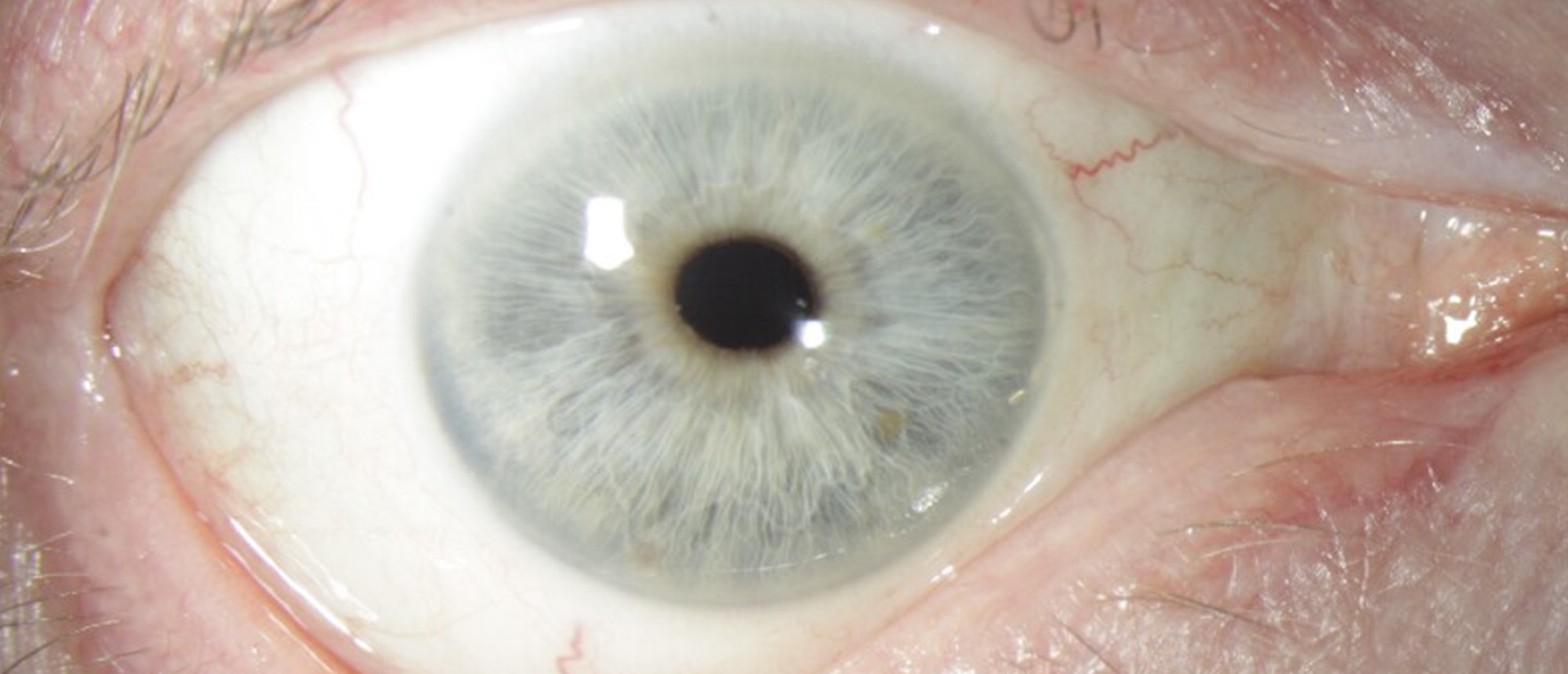 Cyclodialysis Cleft After Atent Implantation