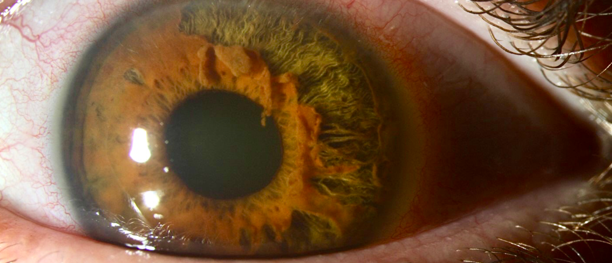 Post-Traumatic Iridoschisis