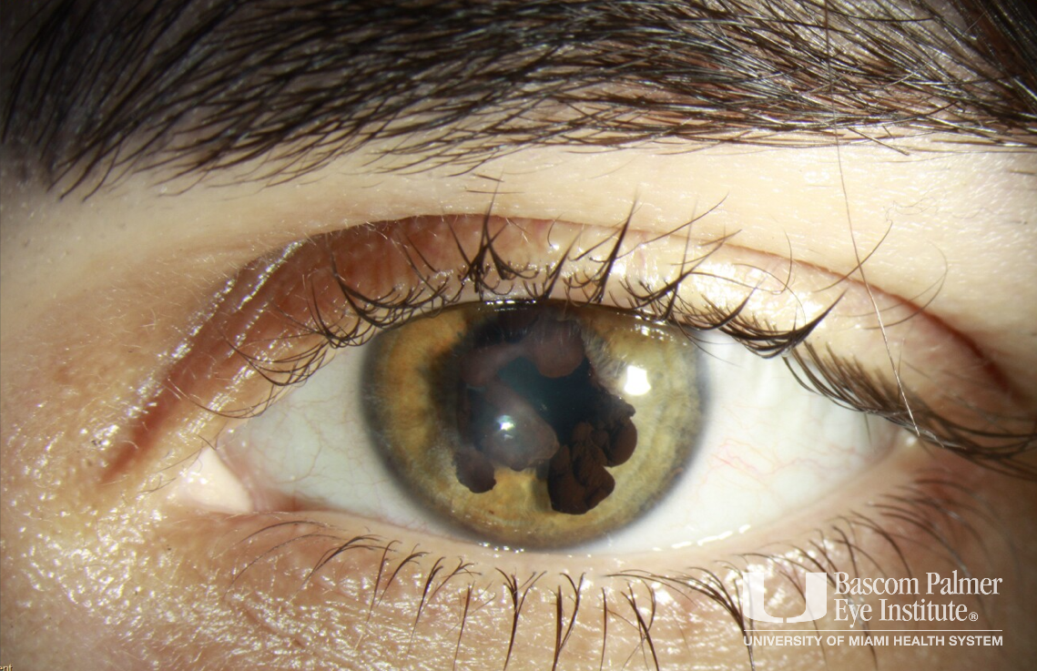 Iris Cyst of Right and Left Eye