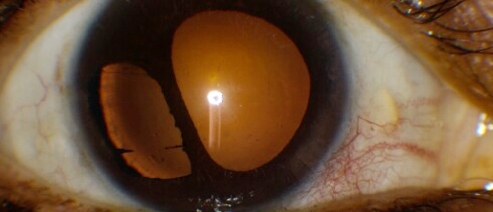 Essential Iris Atrophy