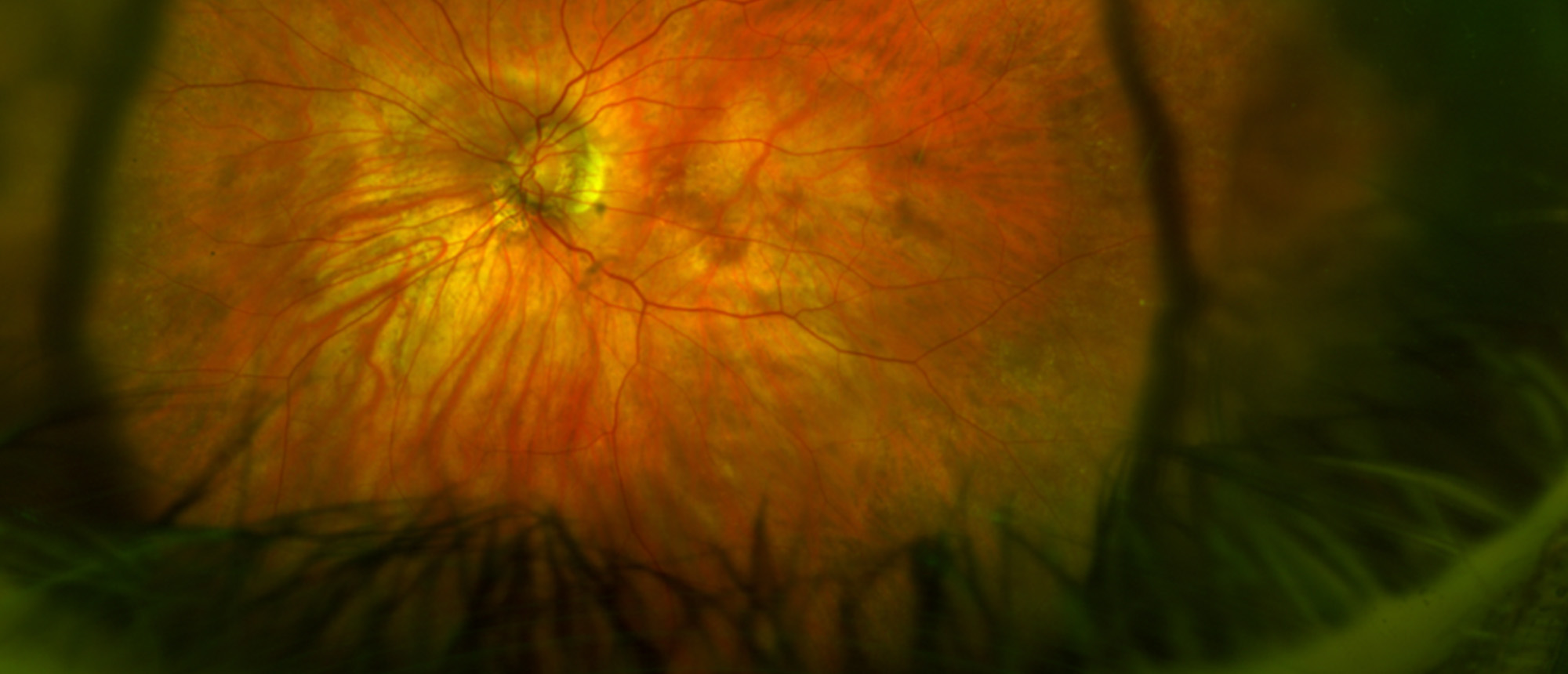 Myopic Traction Maculopathy