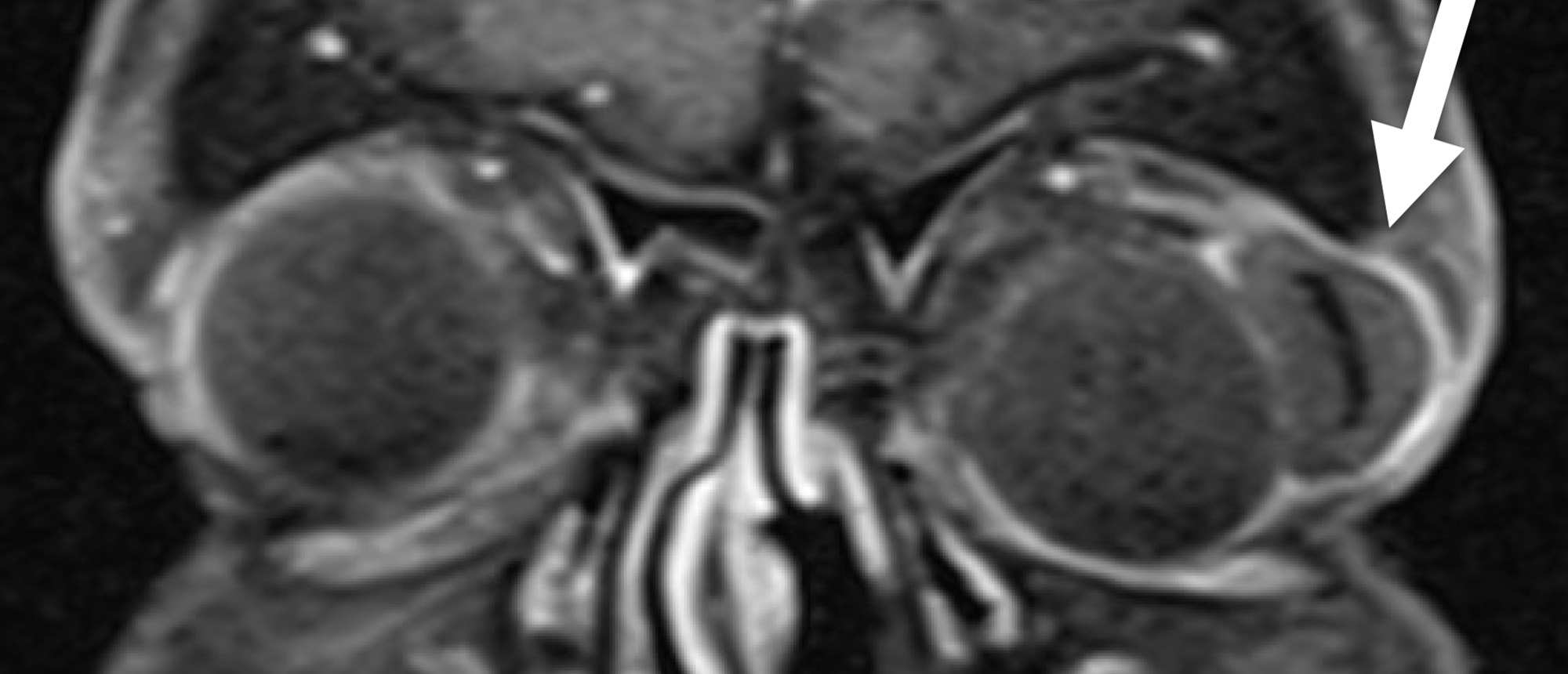 Enlarged Tube-Shunt Bleb After Glaucoma Tube Shunt Implantation