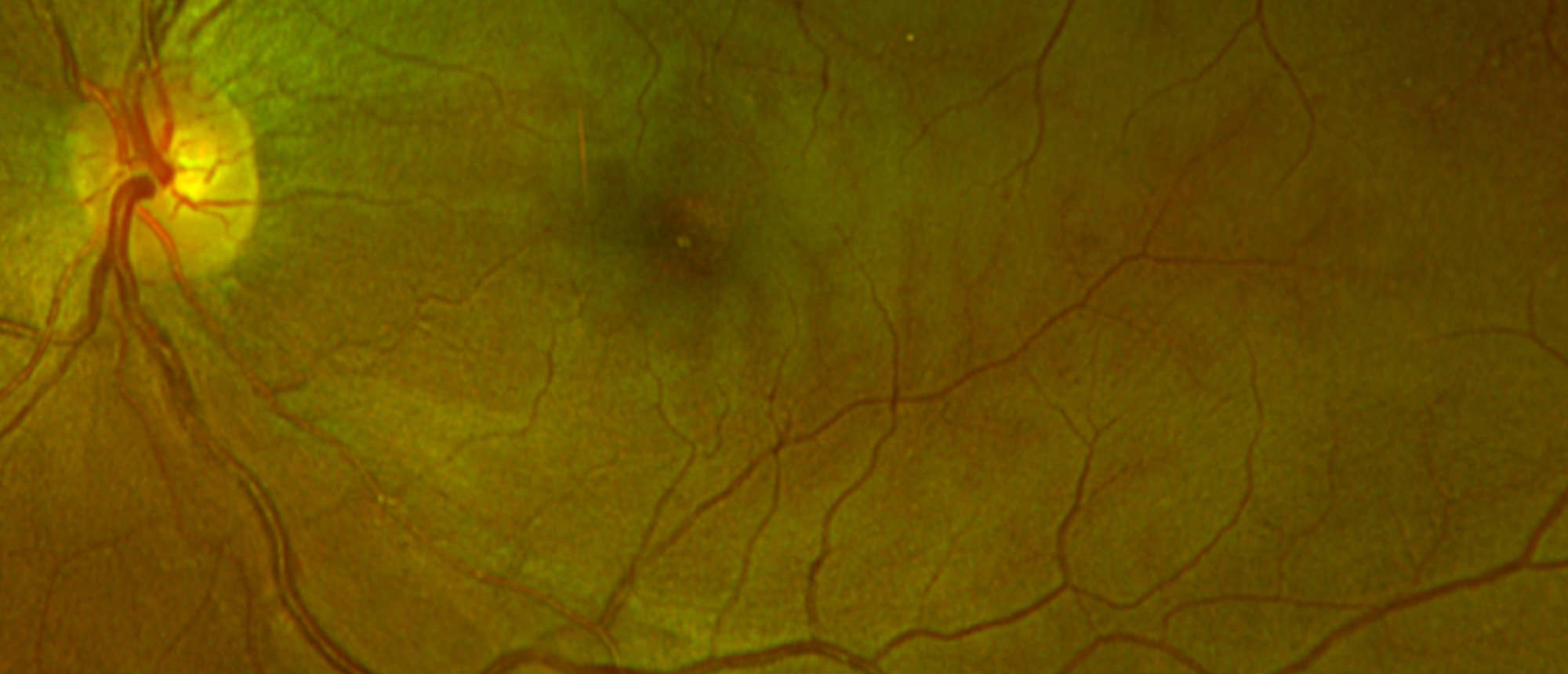 Paracentral Acute Middle Maculopathy (PAMM) Associated with Antiphospholipid Antibody Syndrome and Impending Central Retinal Vein Occlusion