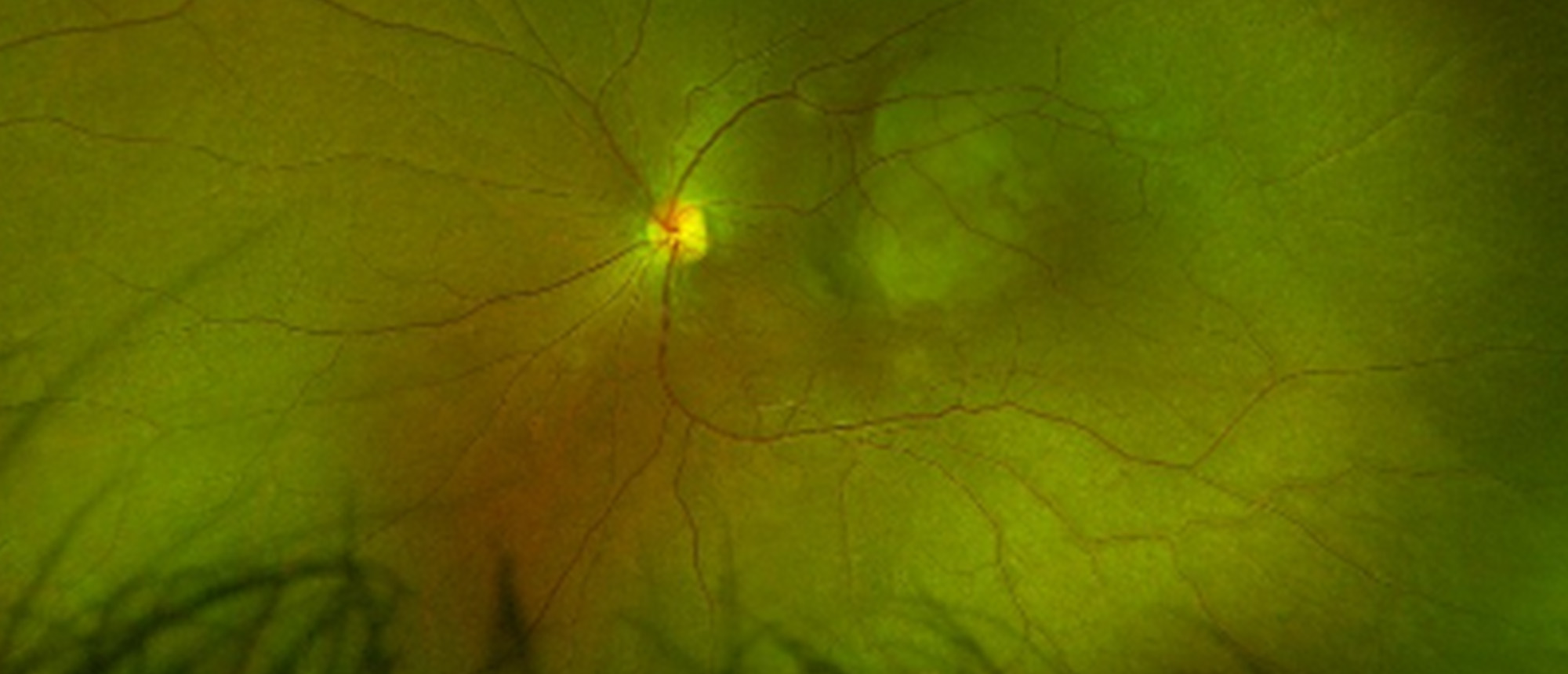Choroidal Granuloma from Presumed Ocular Tuberculosis