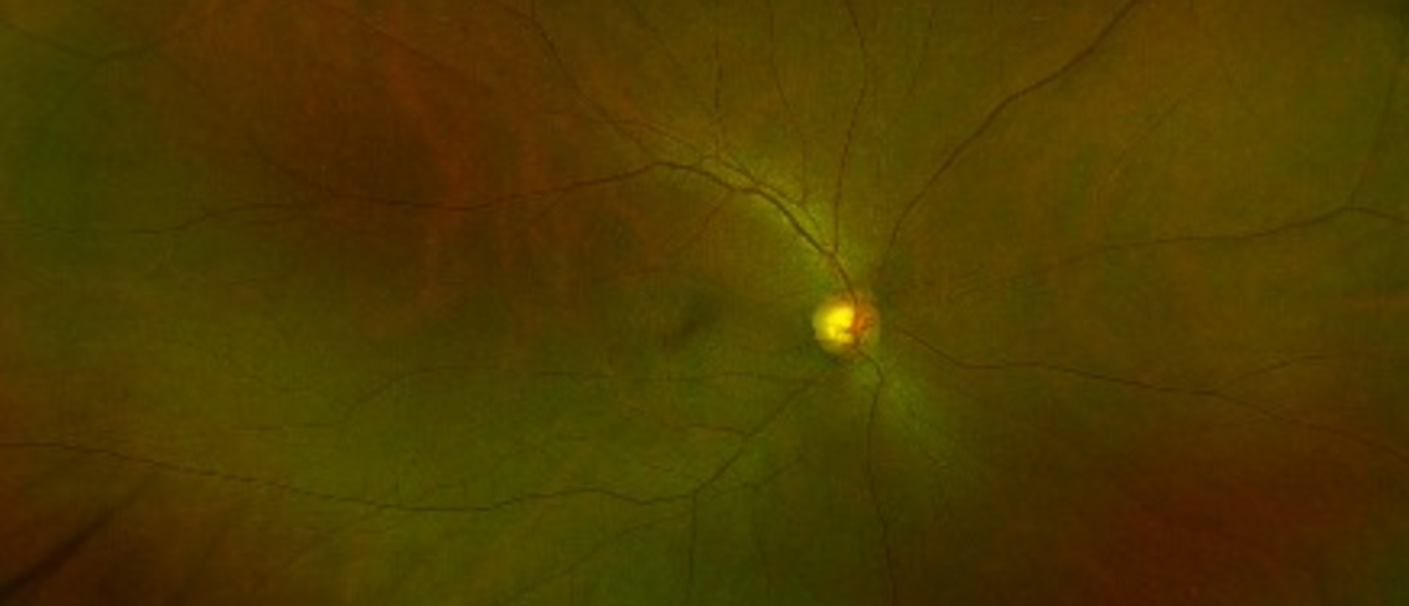 Secondary Vitreoretinal Lymphoma