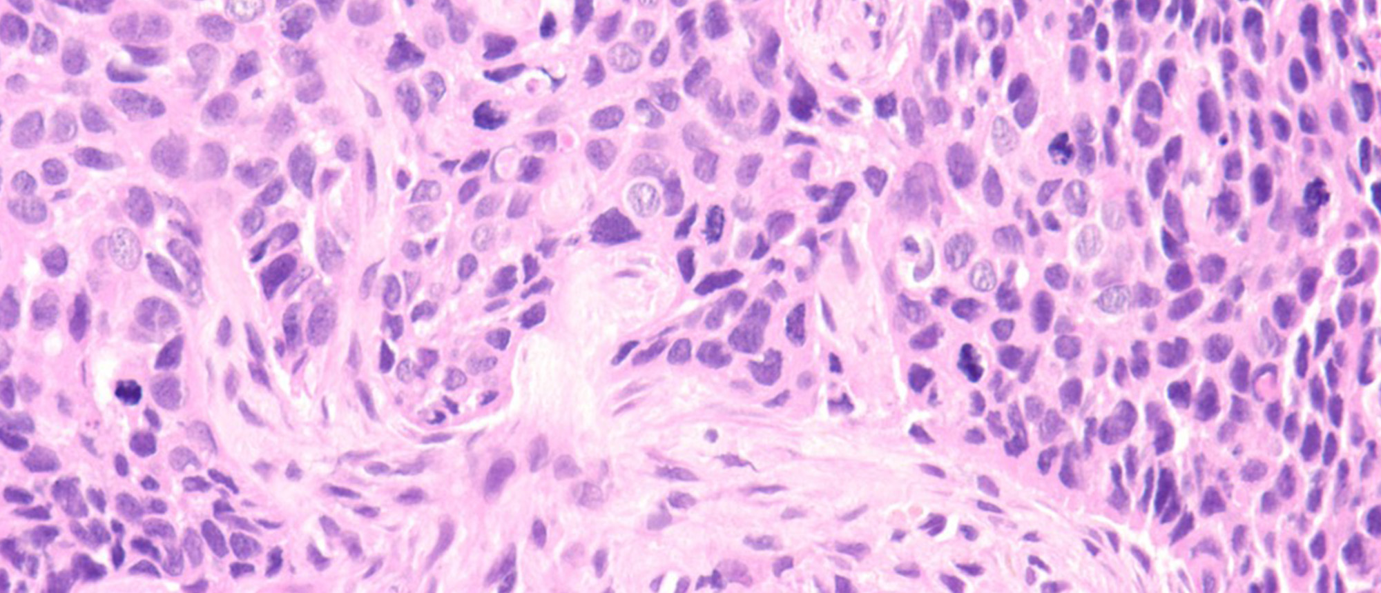 Squamous Cell Carcinoma of the Lacrimal Sac