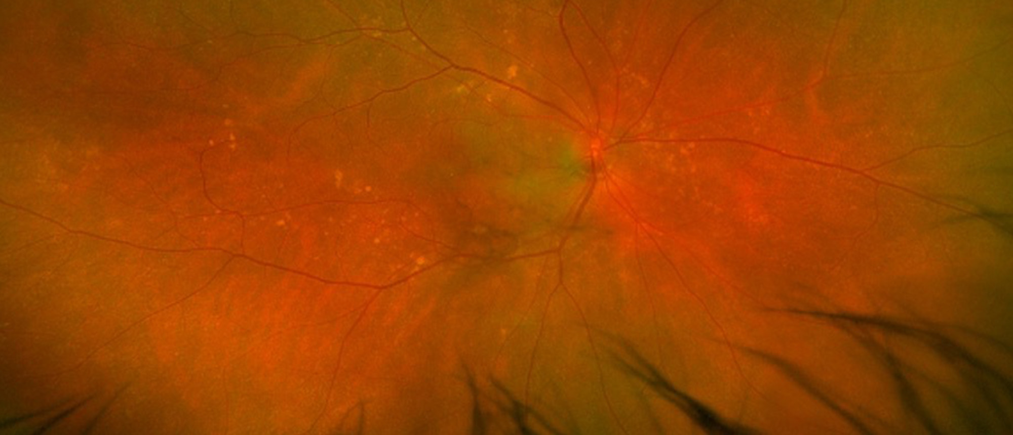 Ciliochoroidal Melanoma with Extraocular Extension Complicated by Sympathetic Ophthalmia