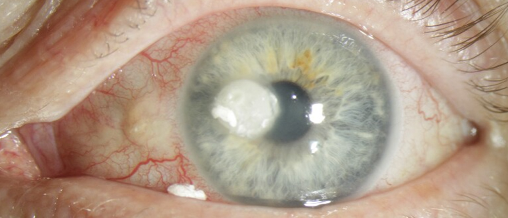 Fungal Keratitis