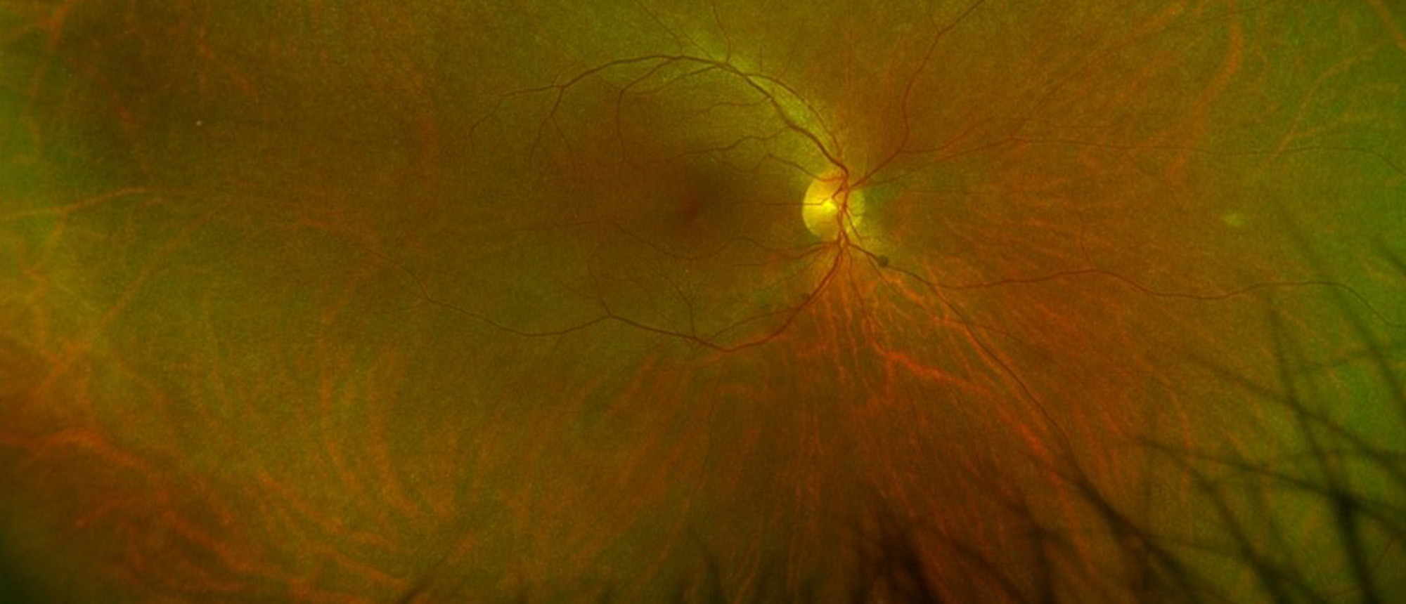 Non-Paraneoplastic Autoimmune Retinopathy