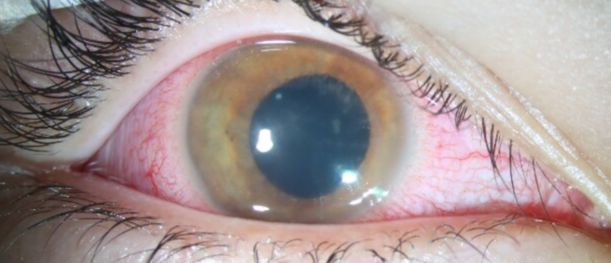 Orthokeratology Lens Related Keratitis