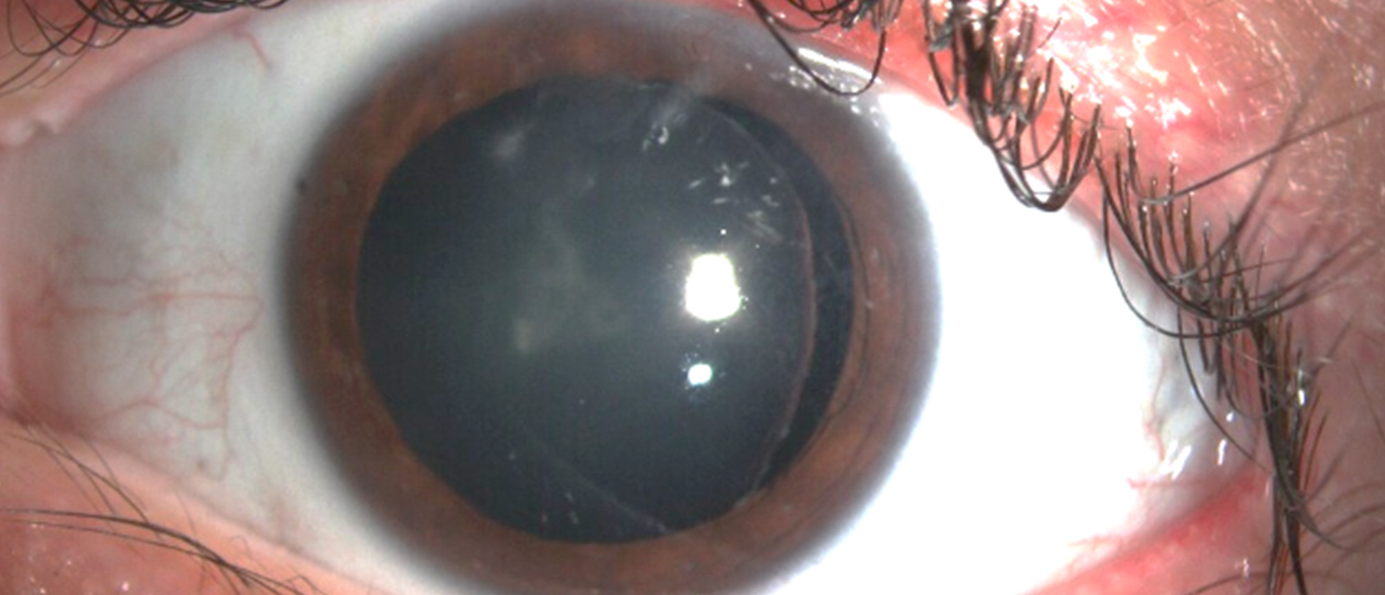 Myotonic Dystrophy Associated Cataracts