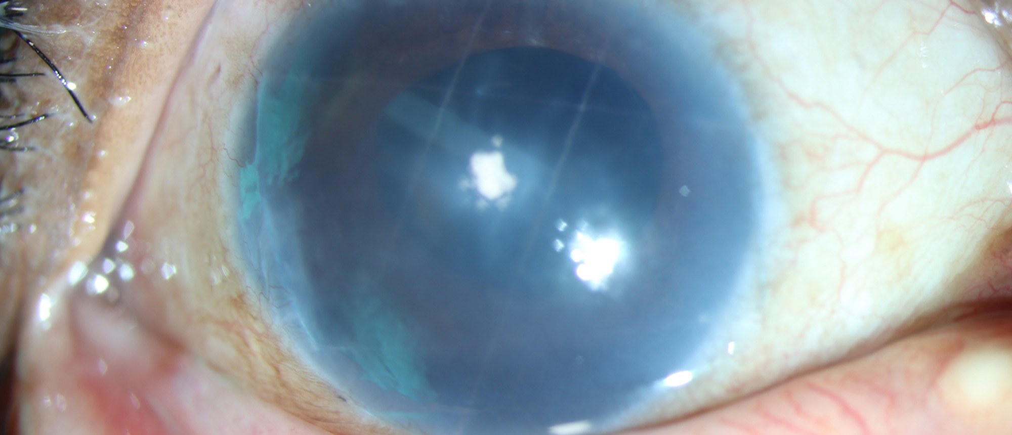 Choroidal Effusion After Glaucoma Drainage Device