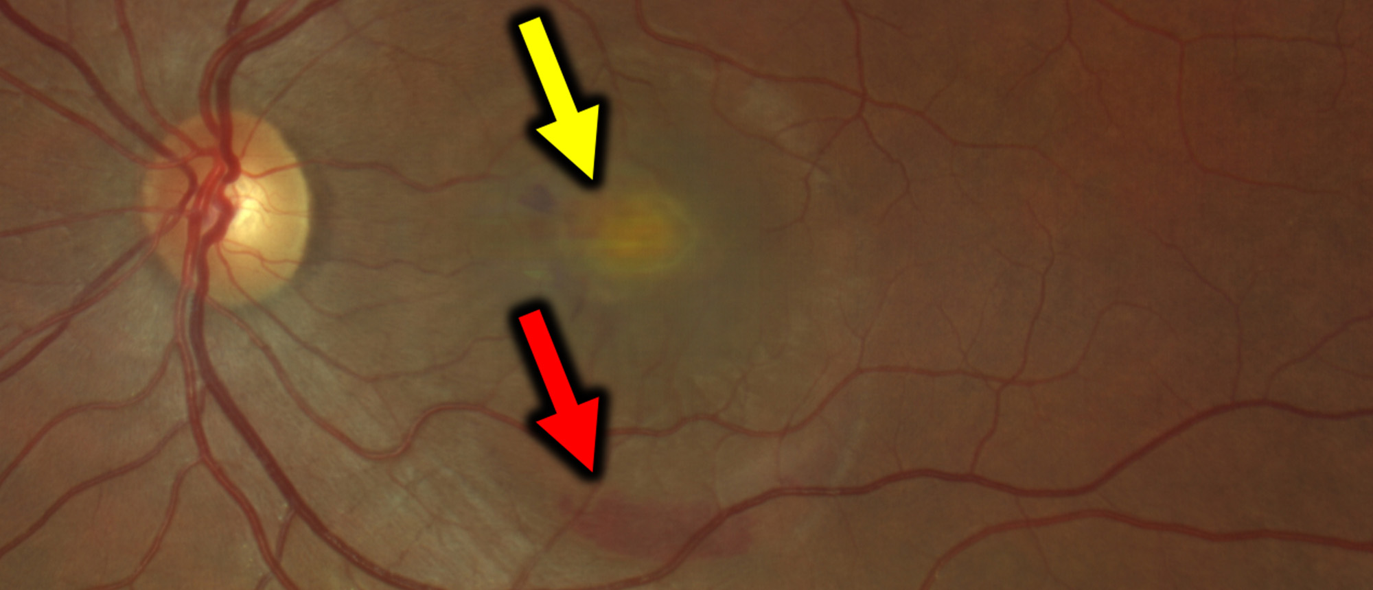 Macular Neovascularization Secondary to Best Disease in a Pregnant Female