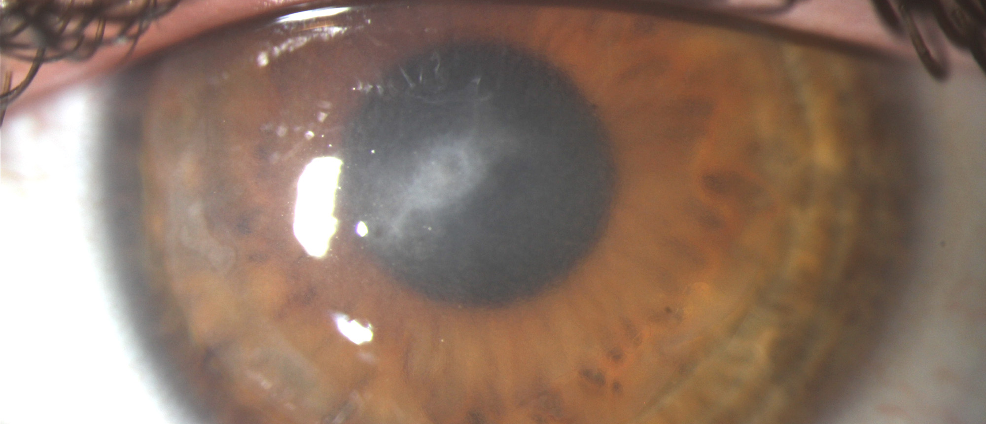 Pressure-Induced Stromal Keratopathy (PISK) and Corneal Scarring After Infectious Keratitis