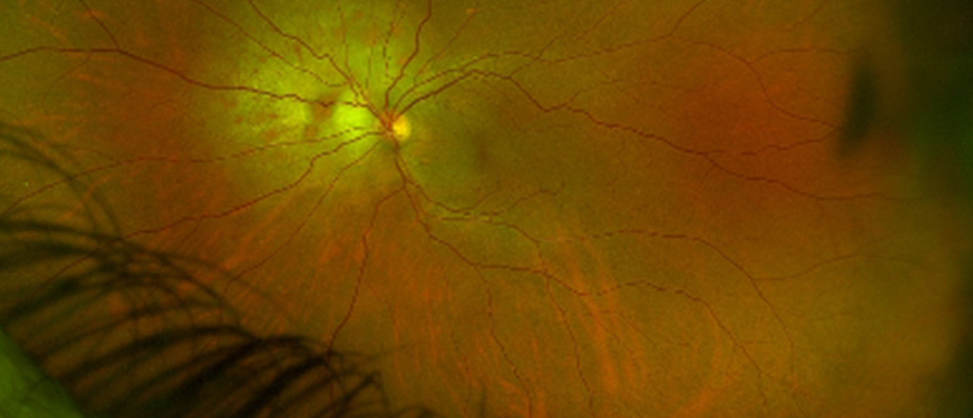Choroidal Metastasis