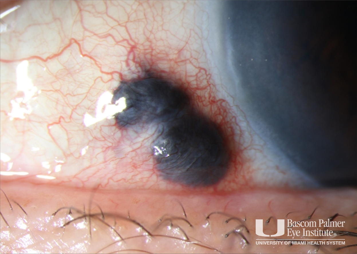 Ciliochoroidal Melanoma with Extraocular Extension Associated with Sympathetic Ophthalmia