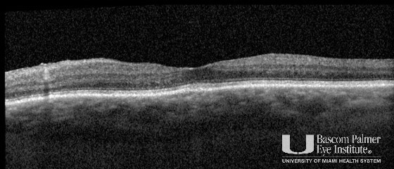 Ciliochoroidal melanoma with extraocular extension associated with sympathetic ophthalmia