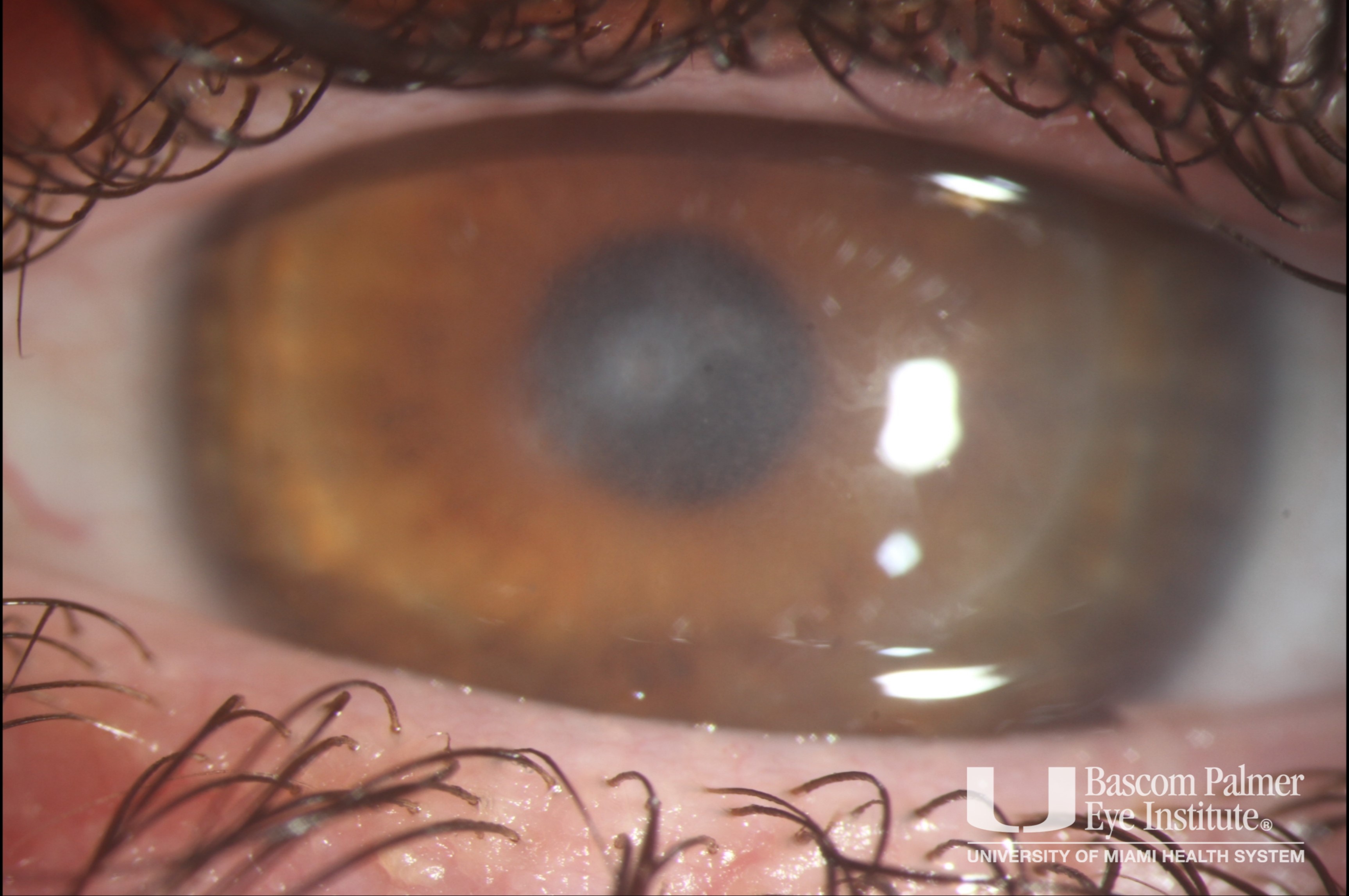 Post LASIK infectious keratitis and pressure-induced stromal keratopathy