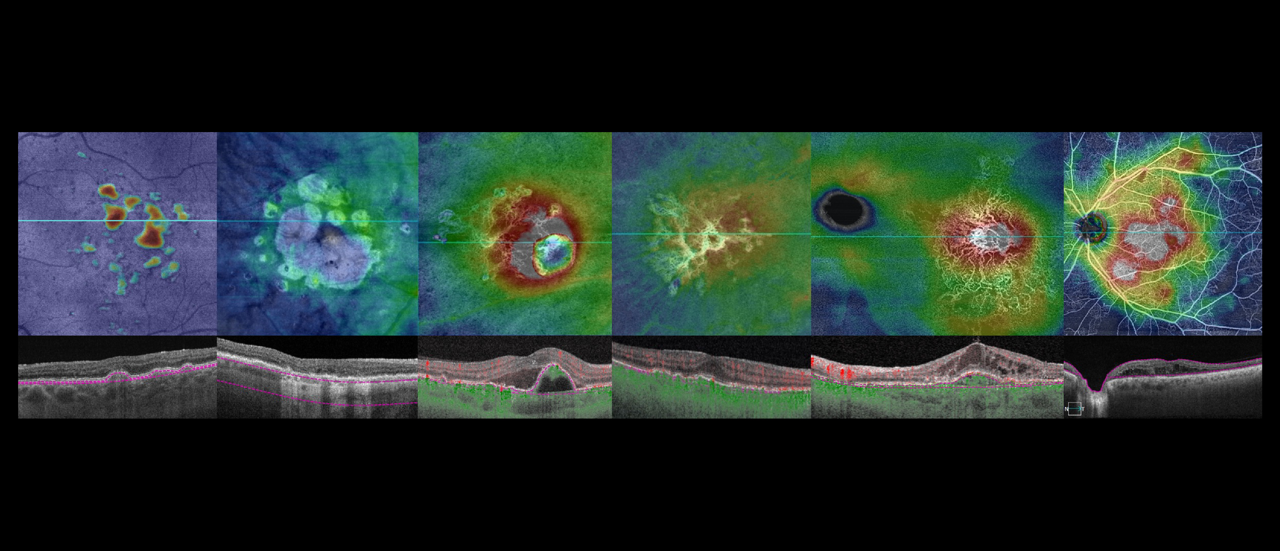 Best of Angiogenesis, Exudation, and Degeneration 2024 – Virtual Edition