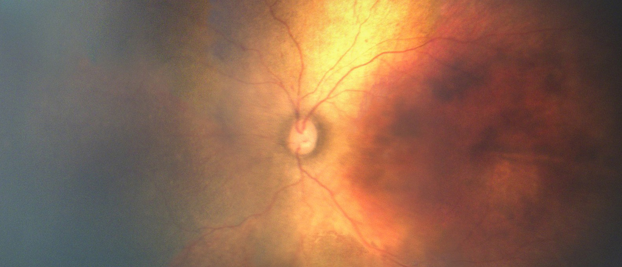 Familial Exudative Vitreoretinopathy and Retinopathy of Prematurity