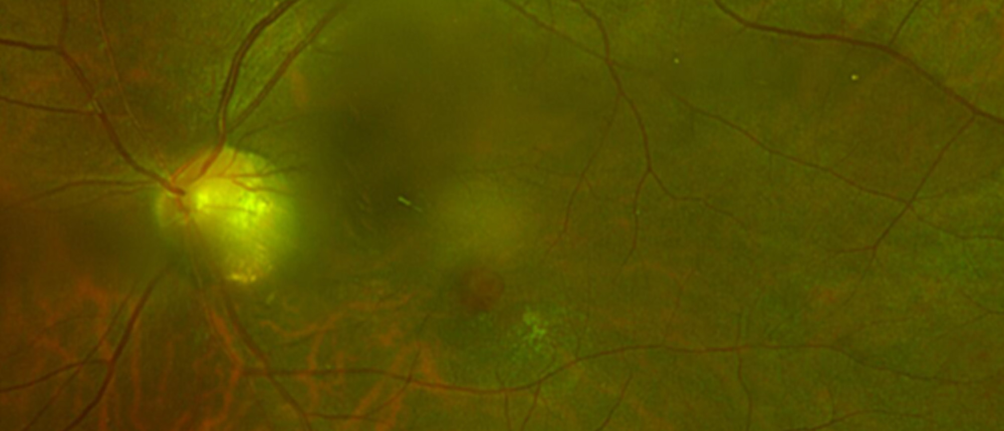 Full Thickness Macular Hole