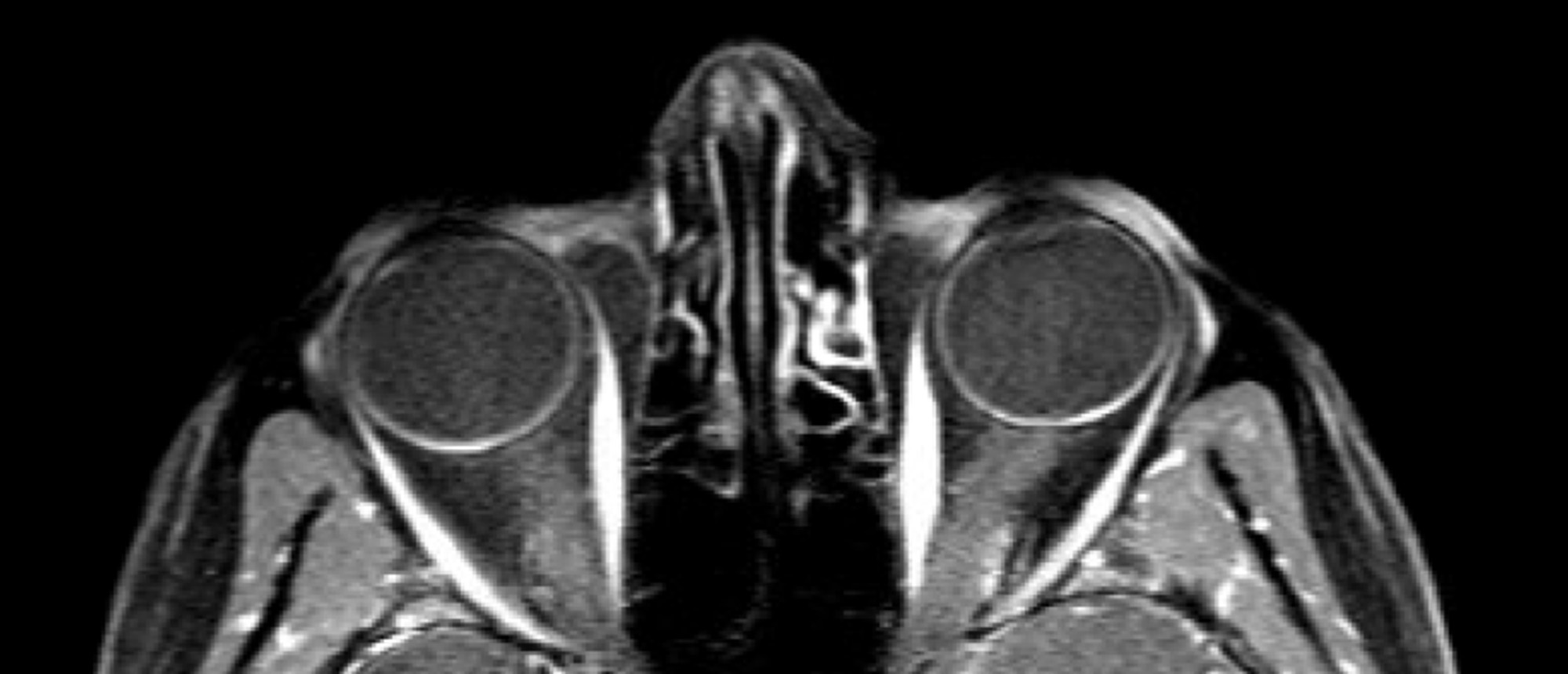 Ethambutol Induced Optic Neuropathy