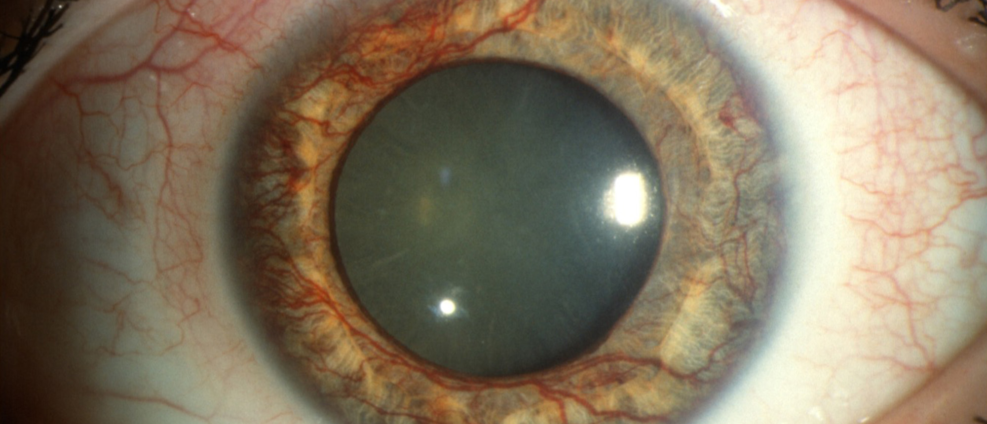IRVAN (Idiopathic Retinal Vasculitis, Aneurysms, and Neuroretinitis)