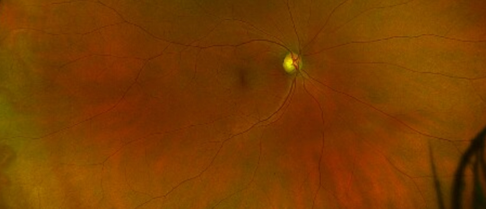 Radiation Optic Neuropathy