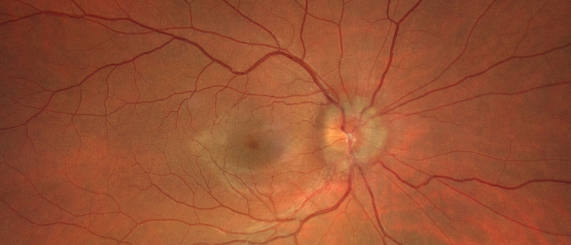 Idiopathic Intracranial Hypertension