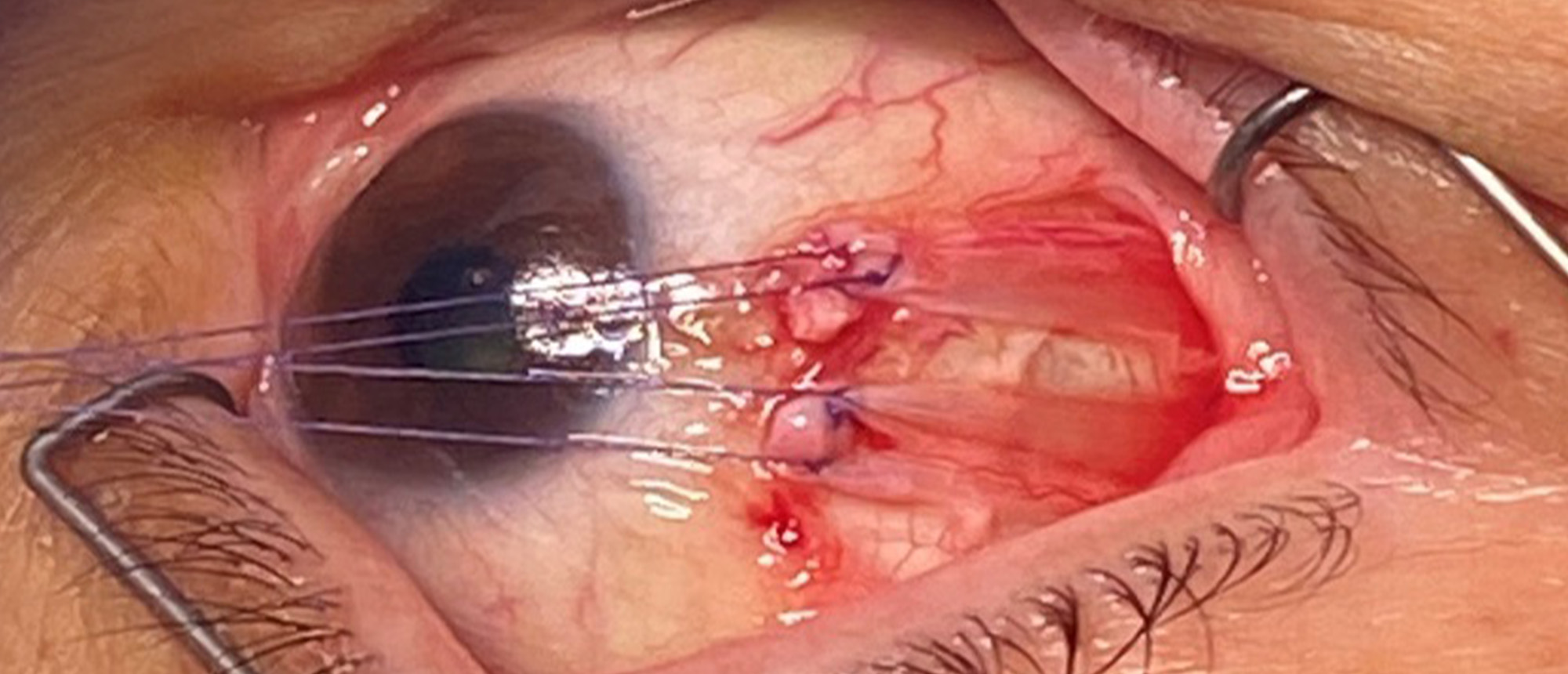 Nuclear 3rd CN Palsy with Vertical Gaze Palsy