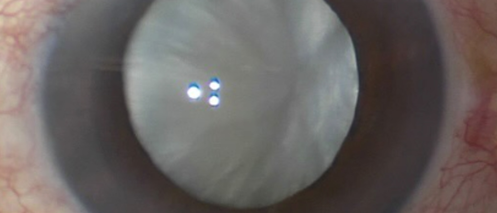 White Cataract with Pre-existing Posterior Capsule Rupture from Intravitreal Injection