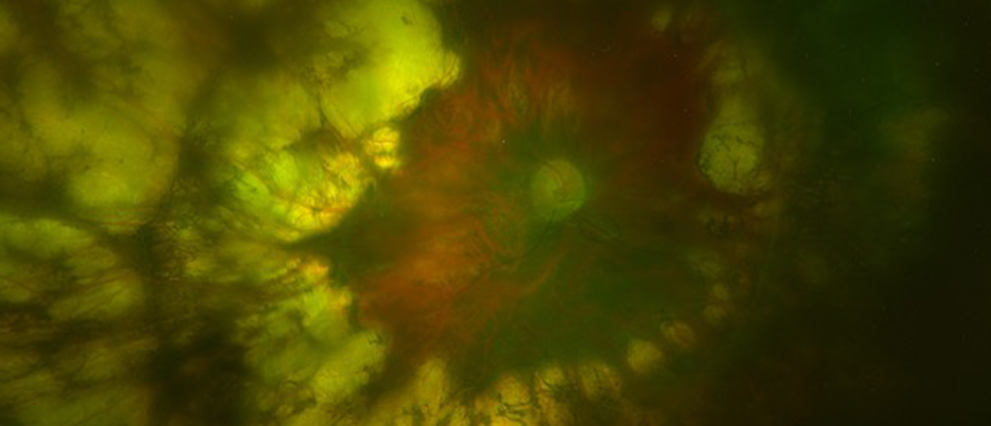 Pachyphakia, Microcornea, and Angle Closure