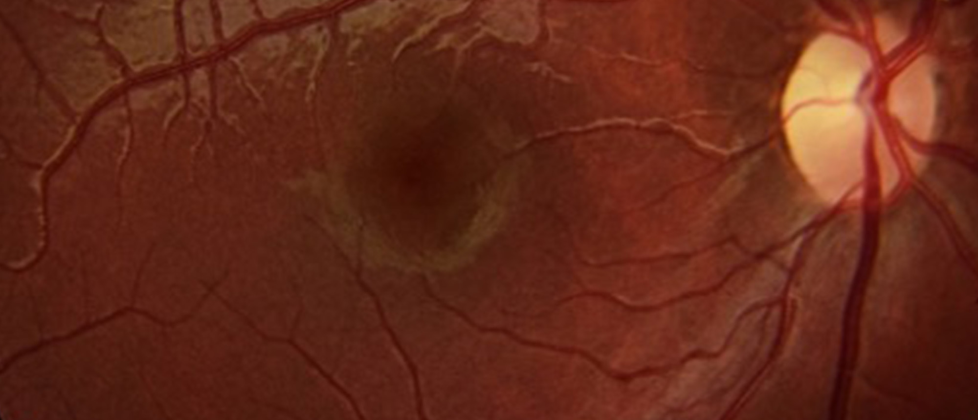 Neuromyleitis Optica