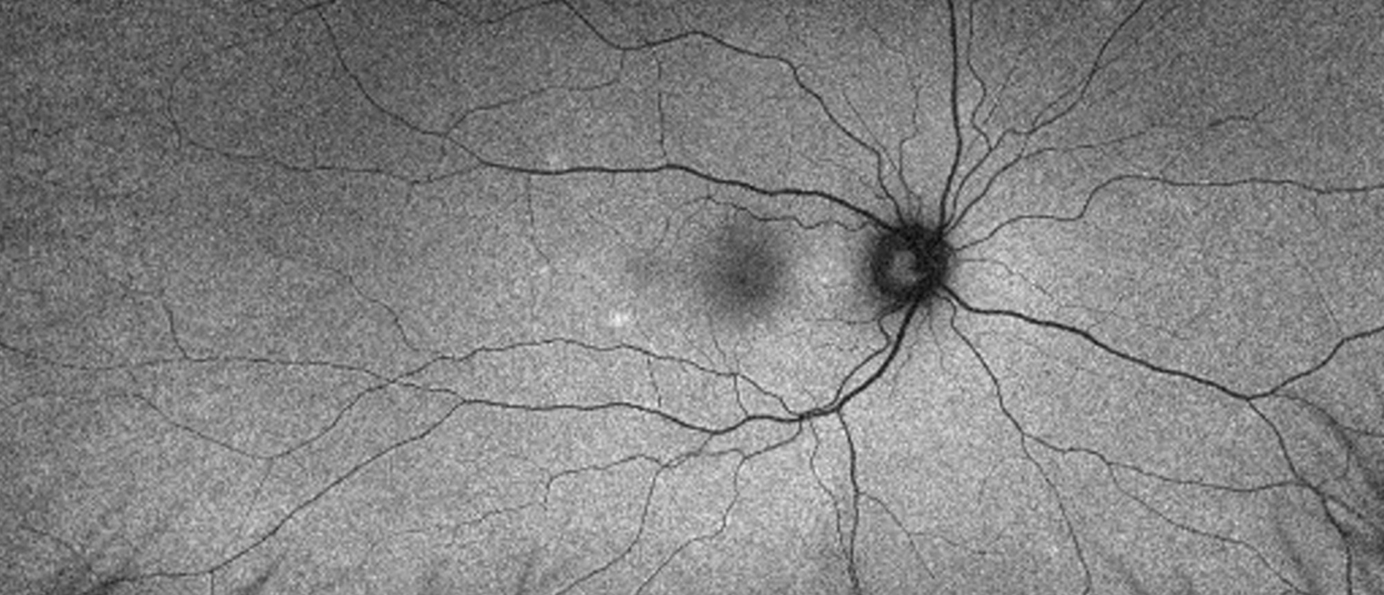 Bartonella Retinitis