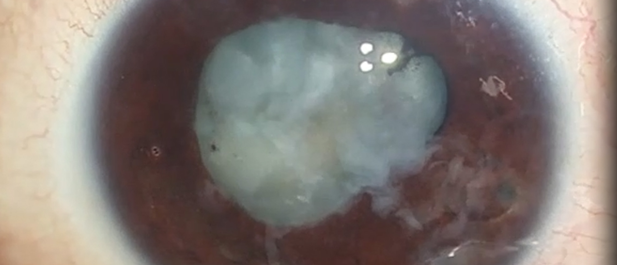 Phacomorphic Glaucoma and Anterior Lens Capsule Rupture After Laser Peripheral Iridotomy