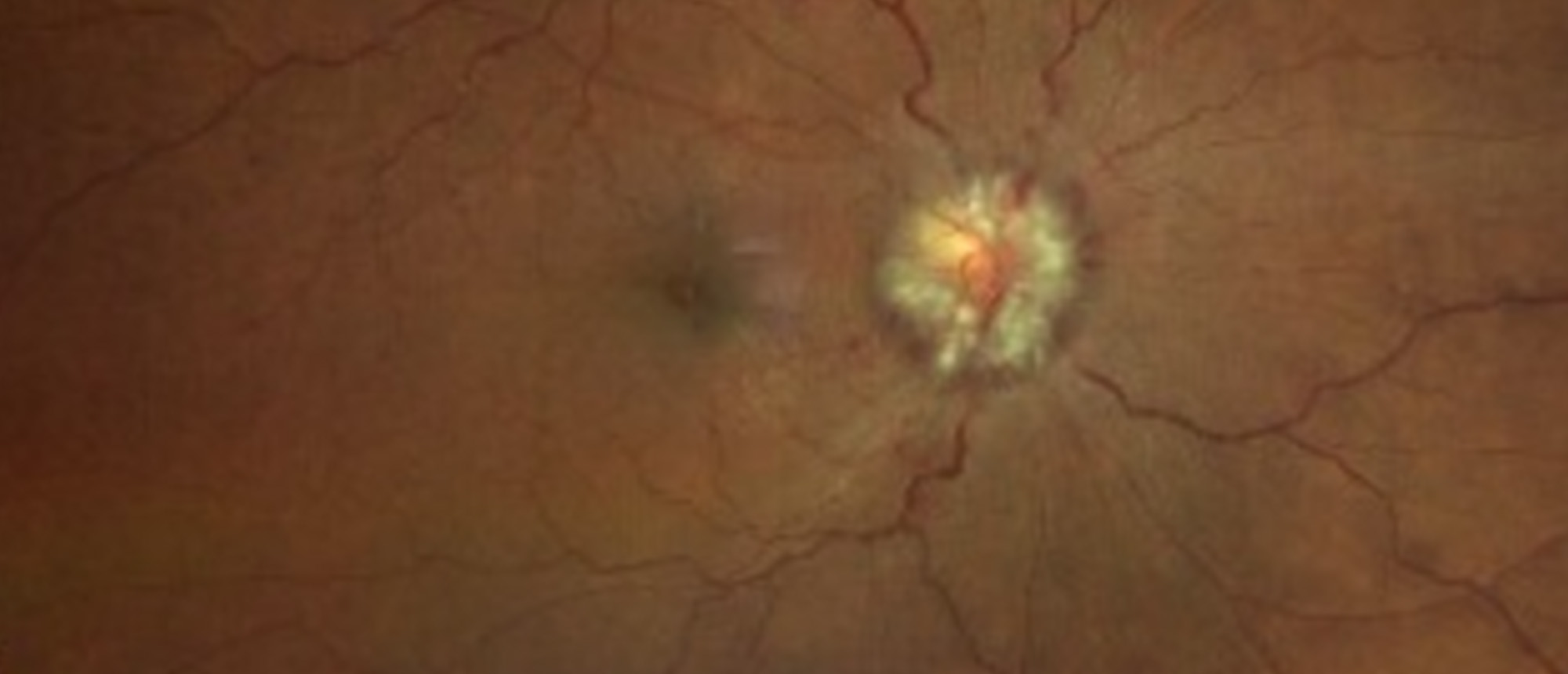 Idiopathic Intracranial Hypertension