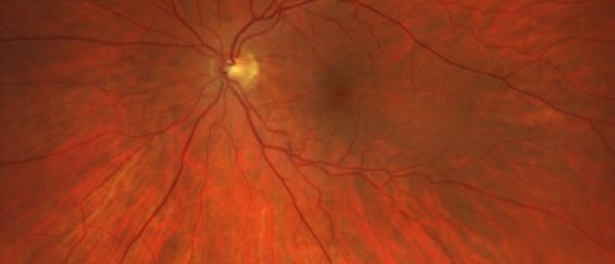 Miller Fisher Syndrome