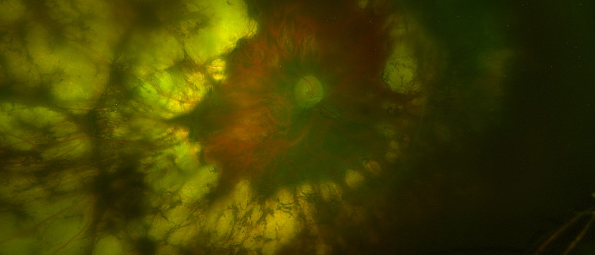 Pachyphakia, Microcornea, and Angle Closure Following Laser Treatment of Retinopathy of Prematurity