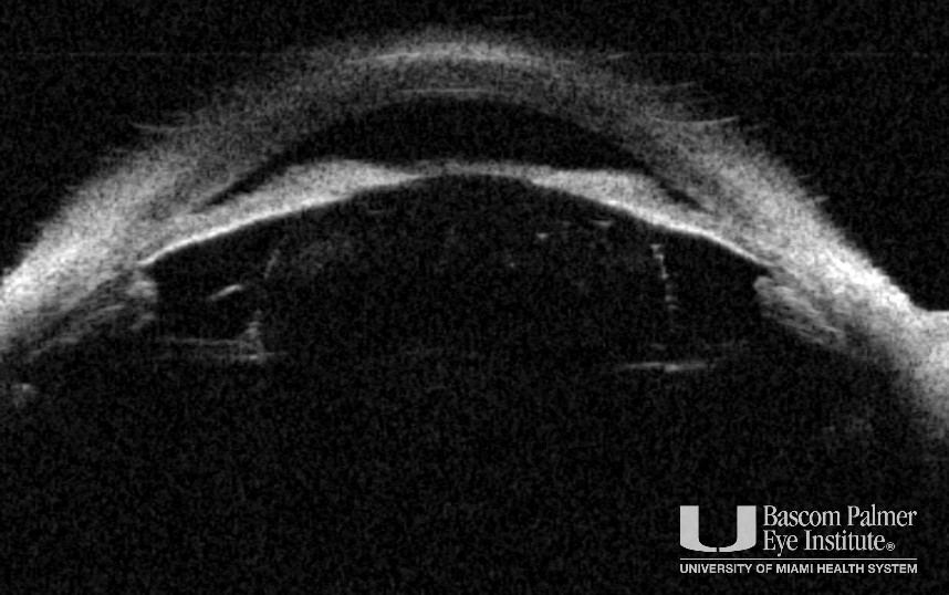 Pachyphakia, Microcornea, and Angle Closure Following Laser Treatment of Retinopathy of Prematurity