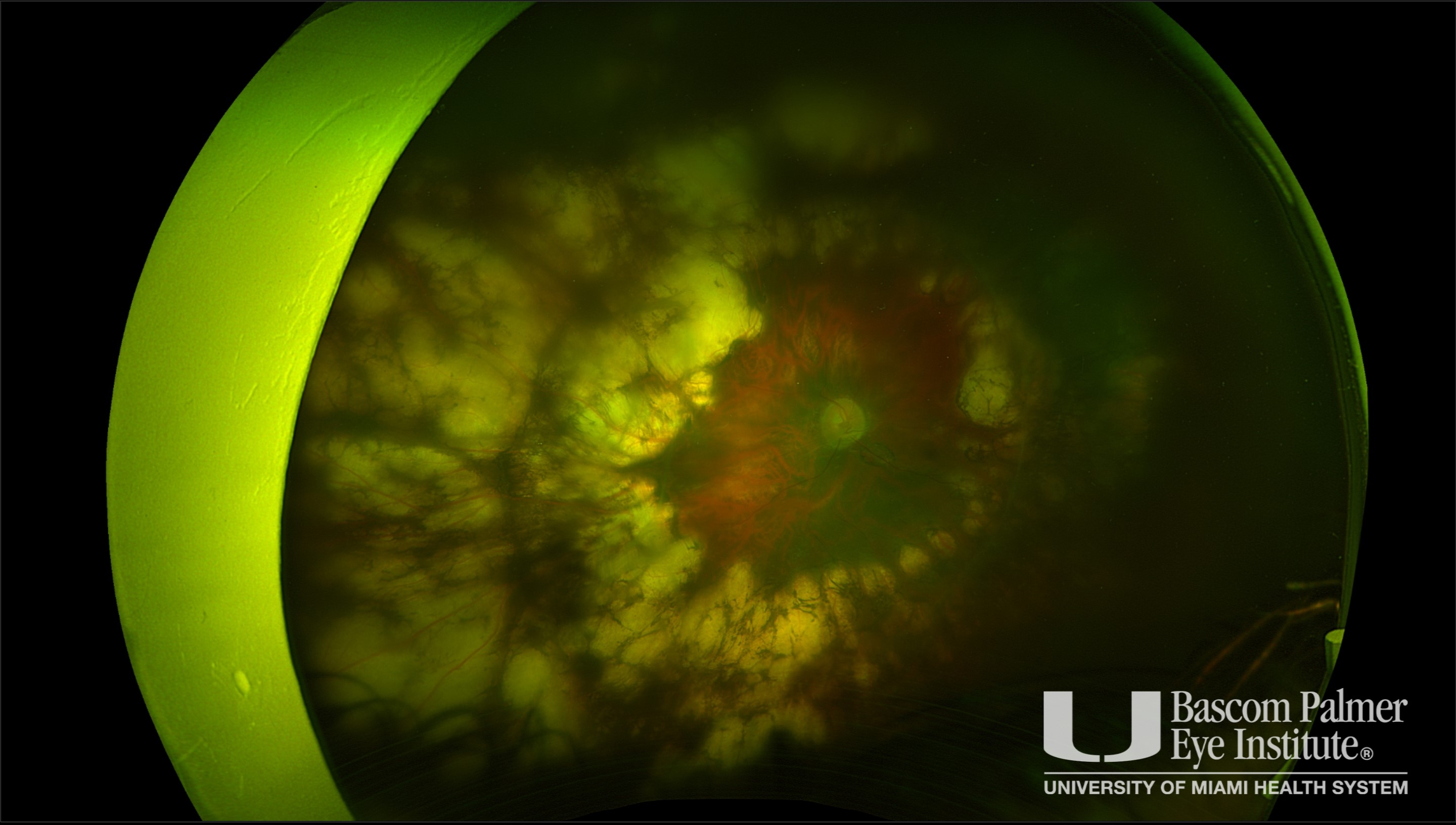 Pachyphakia, Microcornea, and Angle Closure Following Laser Treatment of Retinopathy of Prematurity