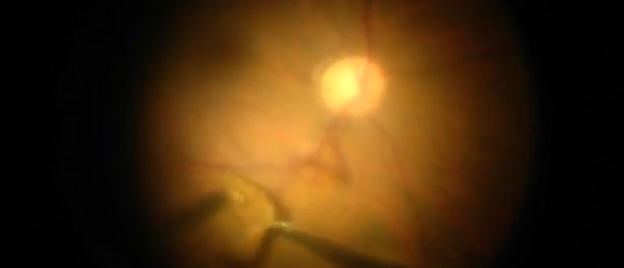 Pars Plana Vitrectomy Clip for Terson's Syndrome