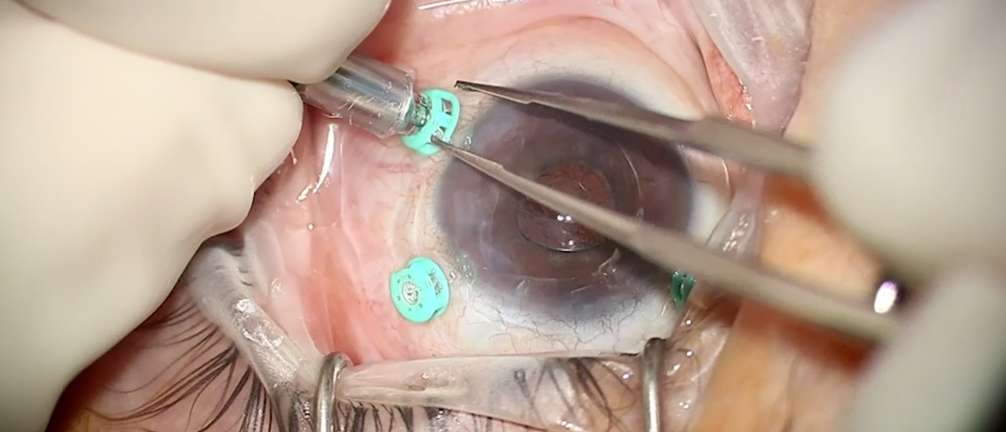 Pars Plana Vitrectomy for Malignant Glaucoma in Nanophthalmos