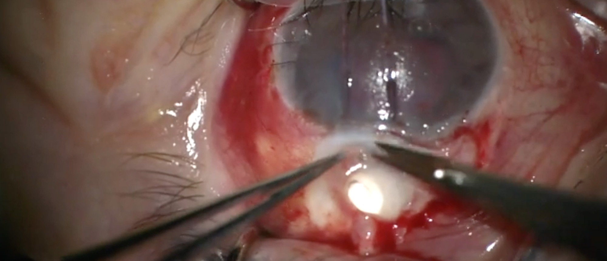 Trabeculectomy Revision after DSAEK
