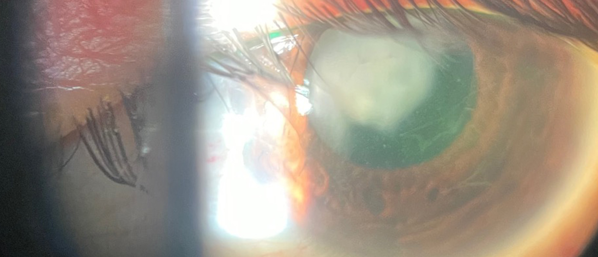 Mixed Mechanism Glaucoma Secondary to Retained Lens Material