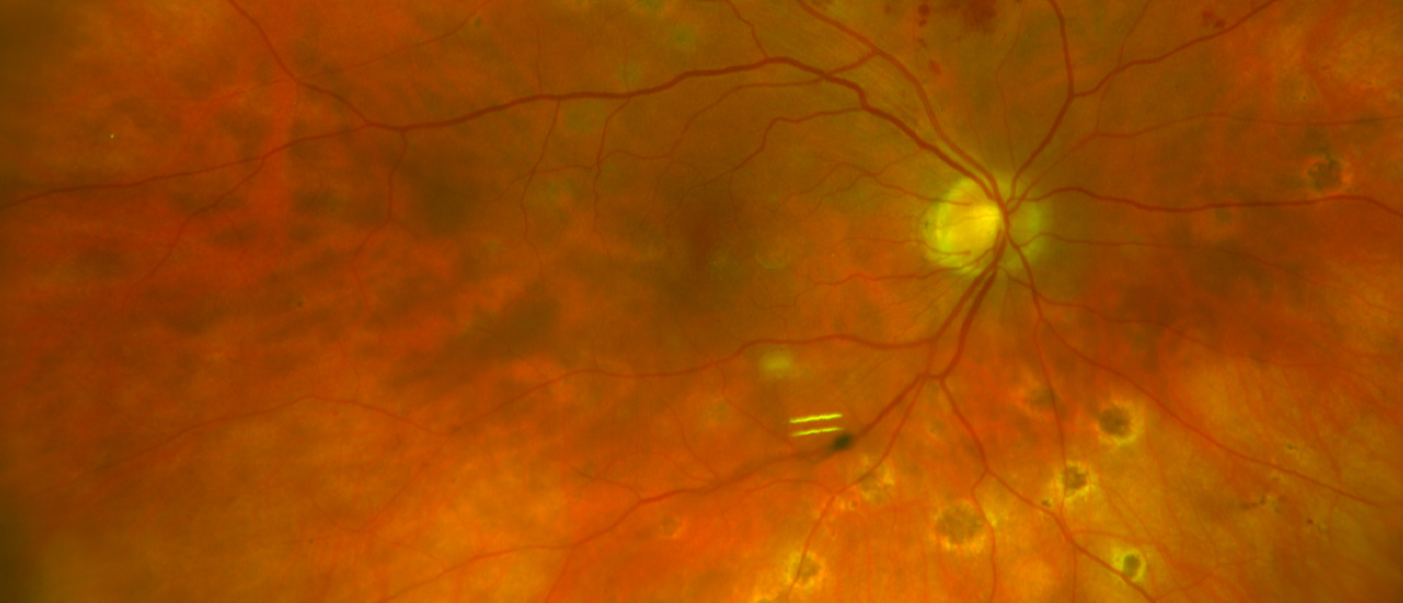 West Nile Virus Chorioretinitis