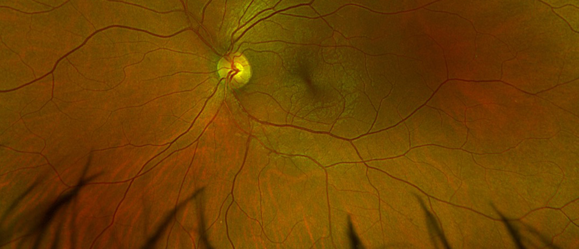 Central Serous Chorioretinopathy