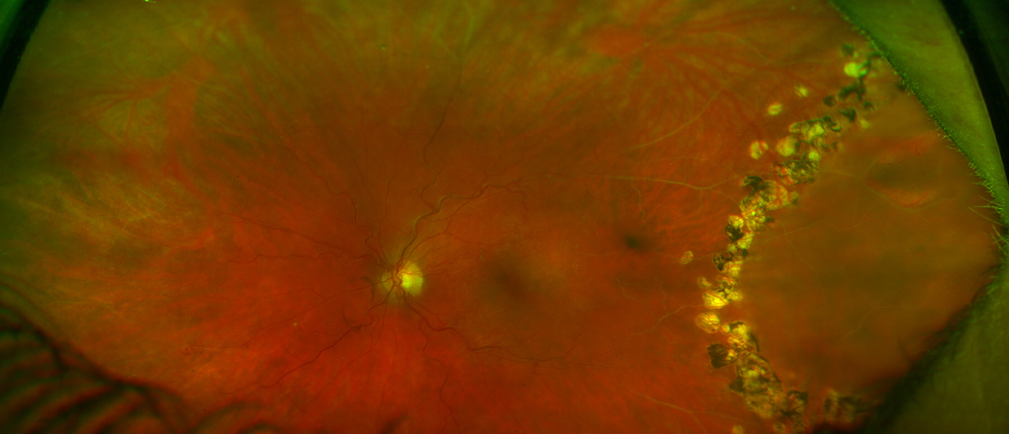 Chronic Retinal Detachment with Laser Demarcation