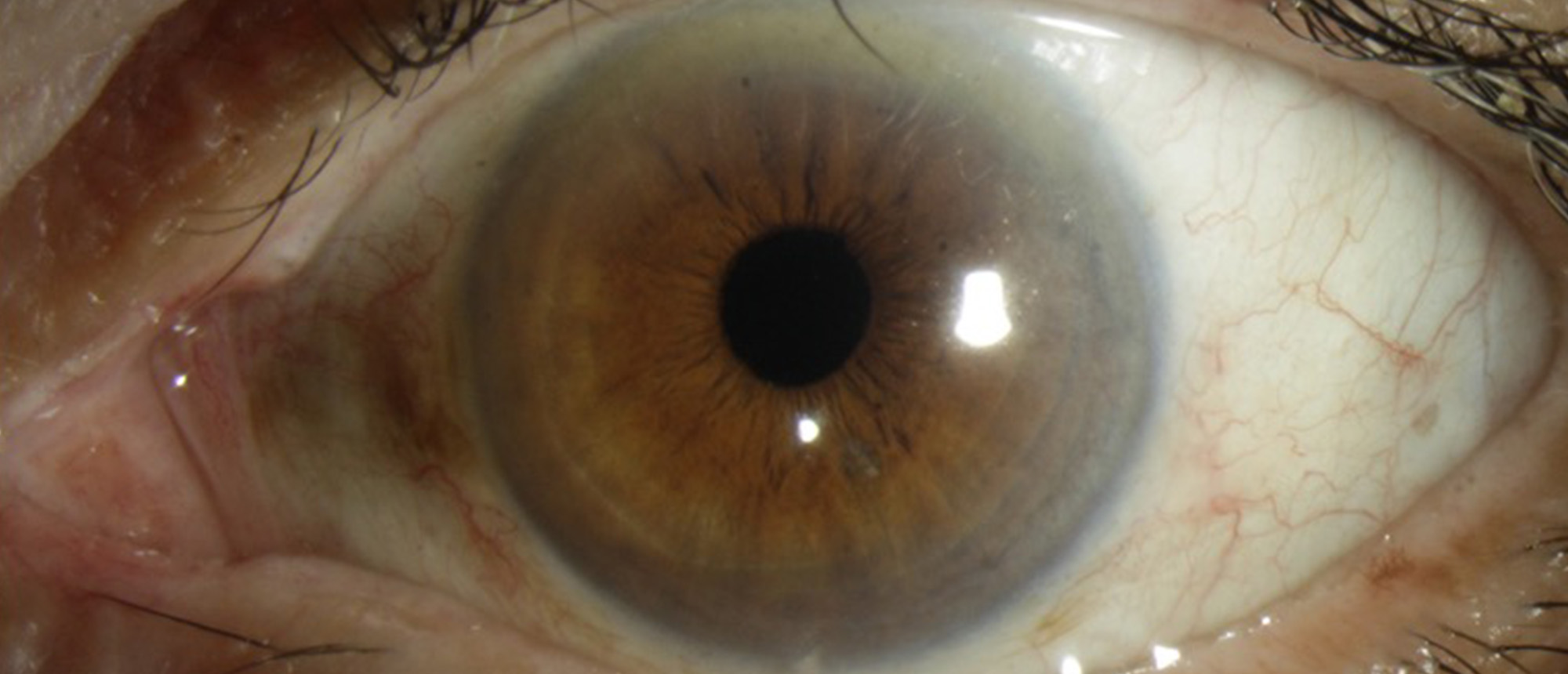 Cicatrizing Conjunctivitis Secondary to Mycobacterium Tuberculosis